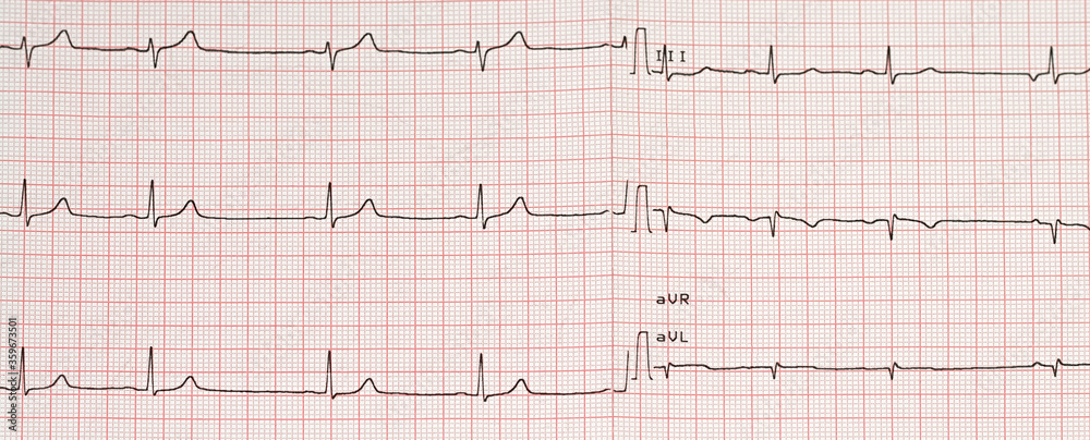 Electrocardiogram example of a normal 12-lead sinus rhythm