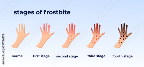 Frostbite stages. Hypothermia in cold season. Medical infographic. Blue and red fingers. Isolated vector illustration in cartoon style