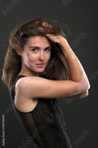 Portrait of beautiful woman with vitiligo.