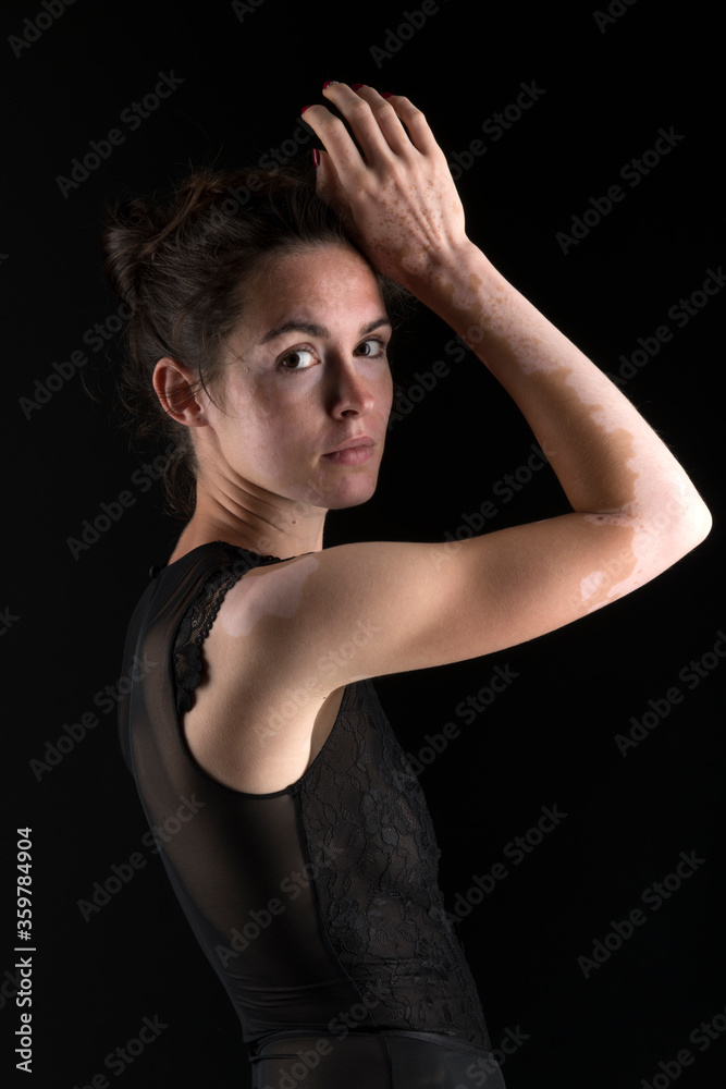 Vitiligo on the hands. Young beautiful woman with vitiligo. Vitiligo on the hands. Young beautiful woman with vitiligo.