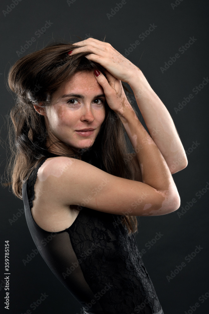 Vitiligo on the hands. Young beautiful woman with vitiligo. Vitiligo on the hands. Young beautiful woman with vitiligo.