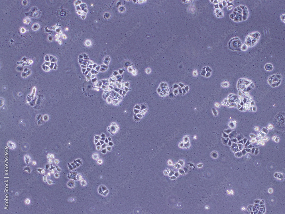 Human Breast Adenocarcinoma Cells or Human Breast Cancer Cell (MCF-7 ...