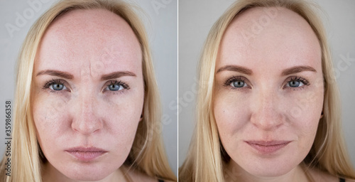Photos before and after mesotherapy, biorevitalization, botulinum toxin injections. Skin fold between eyebrows, forehead wrinkles. At the appointment with a plastic surgeon or cosmetologist photo