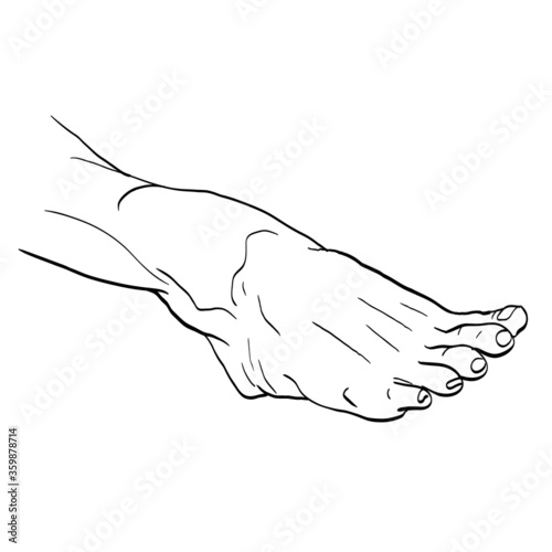 Foot drawn for podiatry problems. Fingers and nails to be restored for the podiatrist