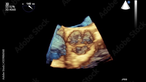 Transesophageal ultrasound video in 3D mode.