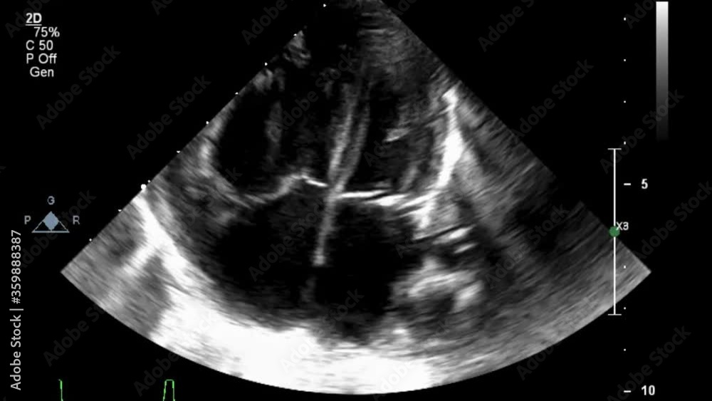 Transesophageal ultrasound video in gray-scale mode.