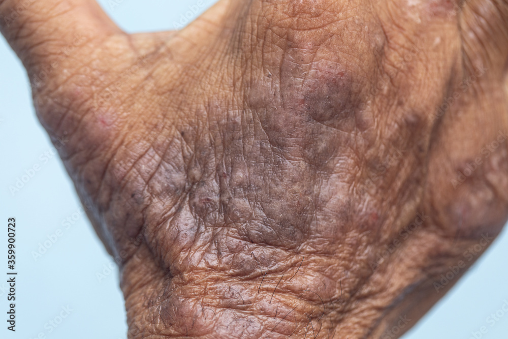 A physical of Atopic dermatitis (AD), also known as atopic eczema, is a type of inflammation of the skin (dermatitis).
