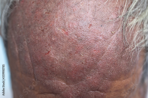 A physical of Atopic dermatitis (AD), also known as atopic eczema, is a type of inflammation of the skin (dermatitis). 
