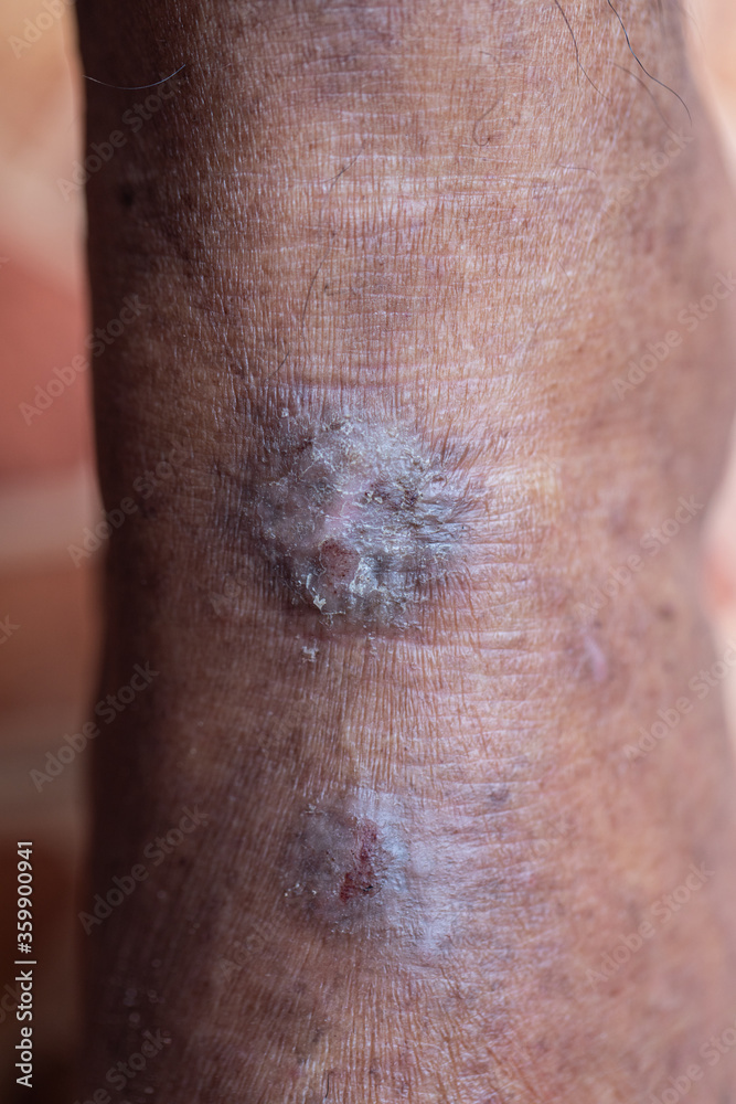 A physical of Atopic dermatitis (AD), also known as atopic eczema, is a type of inflammation of the skin (dermatitis).
A physical of Atopic dermatitis (AD), also known as atopic eczema, is a type of inflammation of the skin (dermatitis).