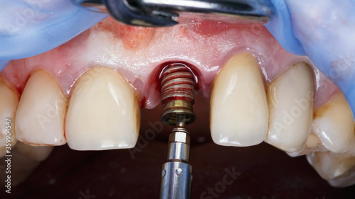 reimplantation dental implant due to complications after surgery photo