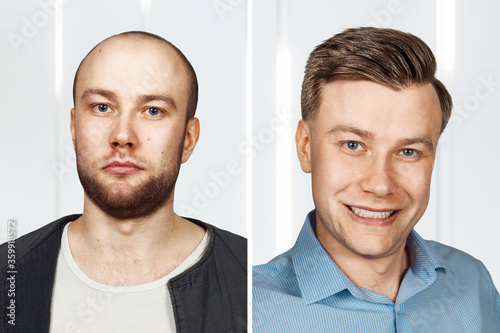 bald Man before and after transplant hair and alopecia