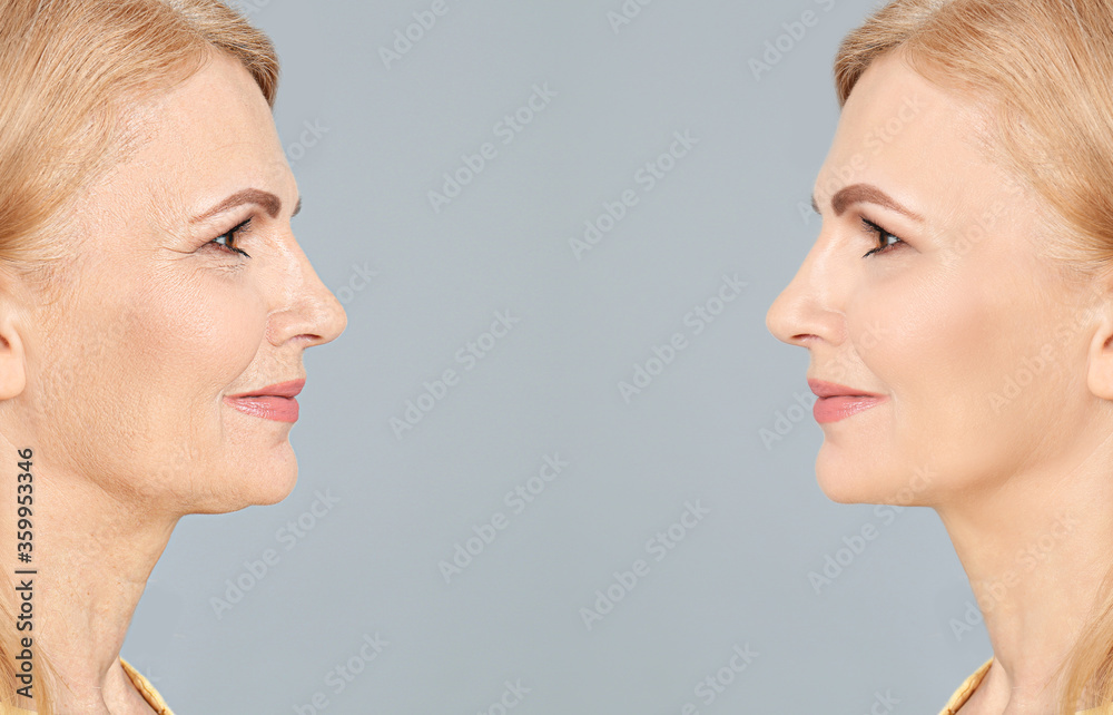 Mature woman before and after cosmetic procedure on grey background Mature woman before and after cosmetic procedure on grey background