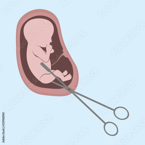 An embryo in the womb and surgical scissors. Abortion is a personal decision of each person. Flat vector illustration. Concept of abortion.