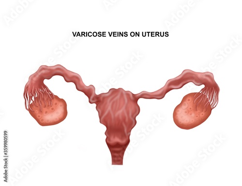 Medical illustration of the varicose veins on uterus photo