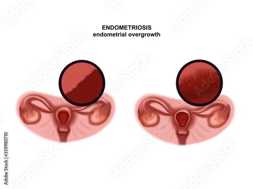 Medical illustration of the uterus and endometriosis photo