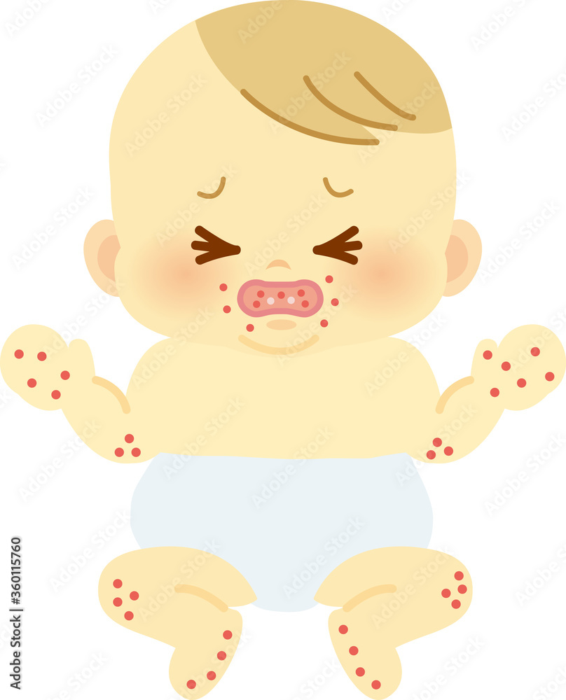 手足口病のおしめ姿の赤ちゃん ベビー全身イラスト24 Stock Vector Adobe Stock