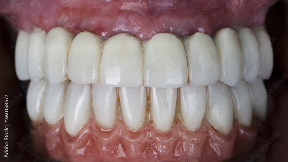 established temporary dental prostheses of the upper and lower jaws in the patient's mouth
