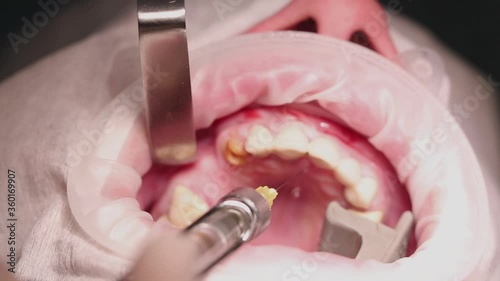 syringe anesthesia, before implantation of the upper jaw