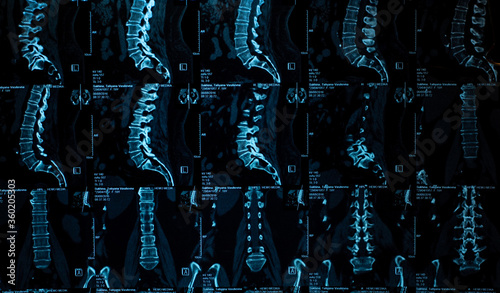 Konstfotografi MRI scans of the lumbosacral spine