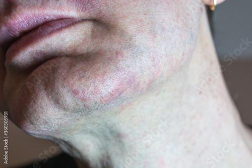 Dermatite seborroica sul viso  photo