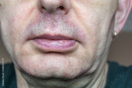 dettaglio del viso dell'uomo con dermatite seborroica photo