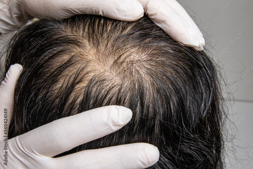Obraz premium Asian man age 40-50 years worried with hair loss problem. He visit dermatologist for his hair fall problem. Checking and treatment concept.