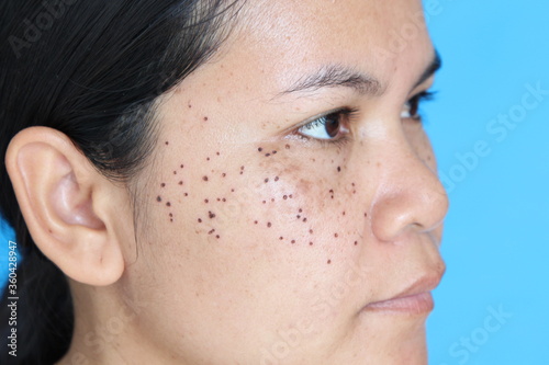Photos Face of ASEAN women That has signs of laser freckle removal On her face