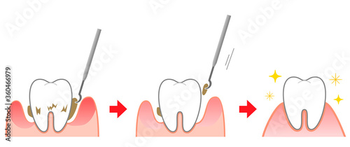 Periodontal disease bleeding toothpaste 　illustrations