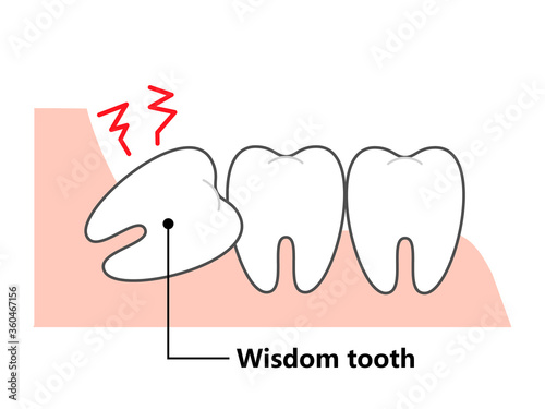  Wisdom tooth and alignment　orthodontic