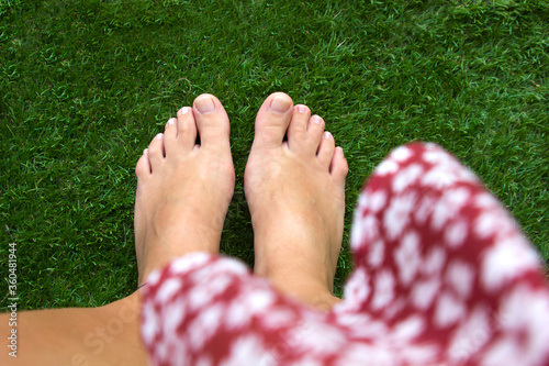 top view of female legs with fused middle toes on green grass background. Webbed toes genetic disorders and syndrome, syndactyly of the toes. Special people. photo