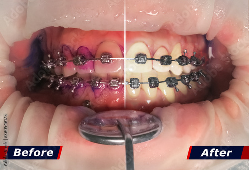 Teeth in braces with the effect Before and After cleaning the tartar. The result of tablets to detect bacteria or plaque on the teeth before cleaning