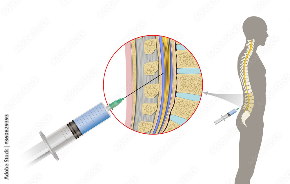 Fototapeta Lumbar puncture also known as a spinal tap, is a medical