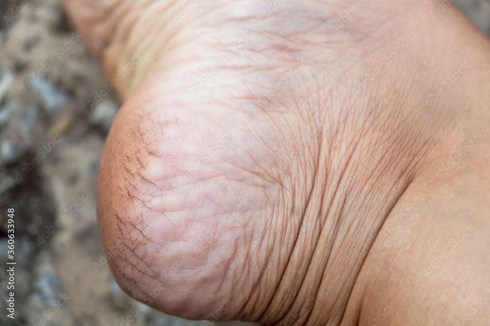 Fototapeta premium Cracked heels and foot with dry skin of woman from dirty. Concept treatment skin care foot and medical podiatrist.