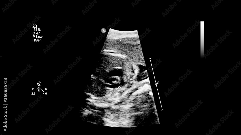 Fototapeta premium Ultrasound screen with fetal echocardiography