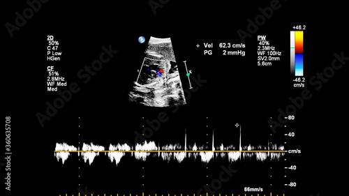 Ultrasound screen with fetal echocardiography