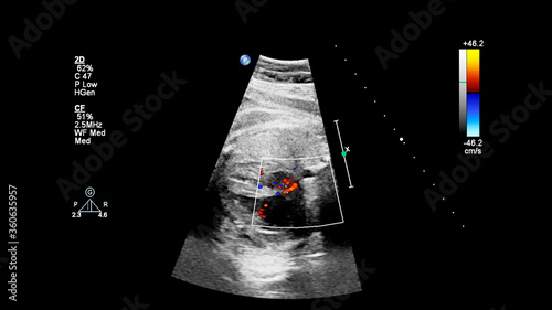 Ultrasound screen with fetal echocardiography