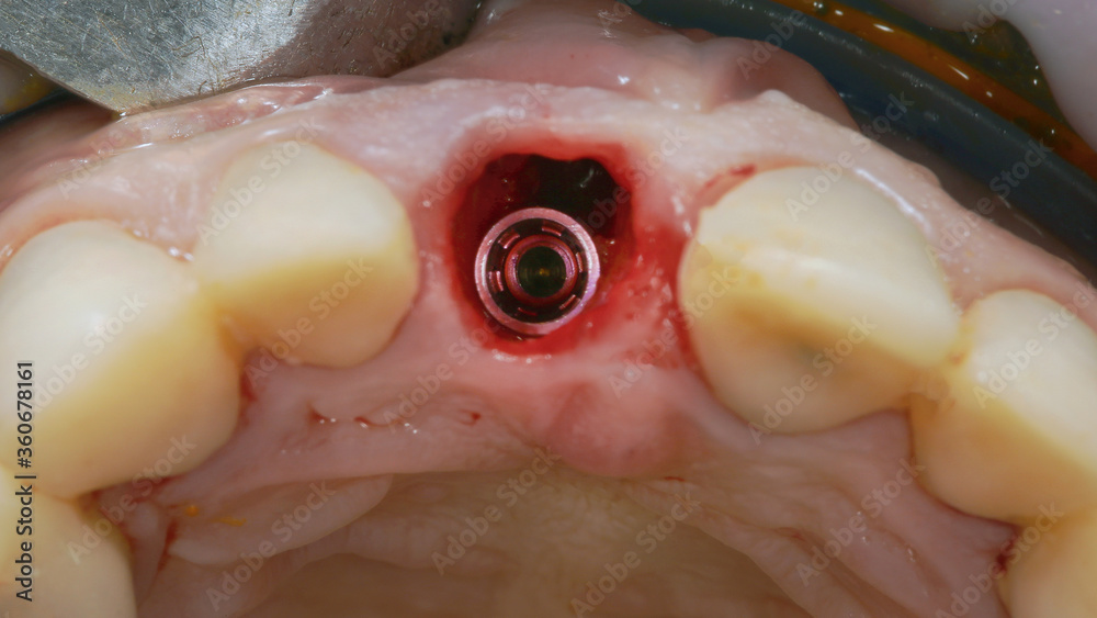 mounted dental implant in the gum cavity through the dental mirror