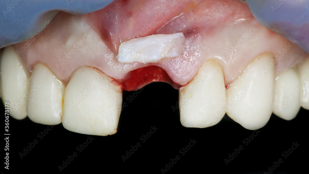 Fototapeta premium gum after implantation with a soft tissue flap to add gum volume