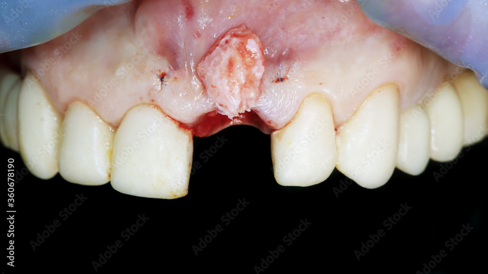 Fototapeta premium gum with a flap of soft and fatty tissue to add gum volume