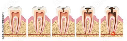 Papier peint Stages of caries development. Periodontitis