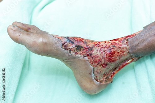 Necrosis and skin surgical wounds in patients with diabetes while undergoing treatment in the intensive care unit. photo