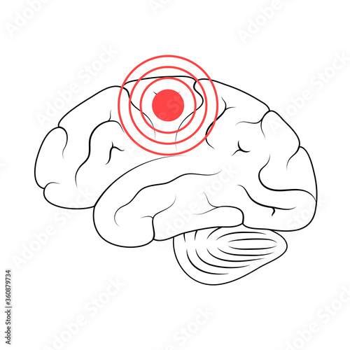 Pain Brain Illustration