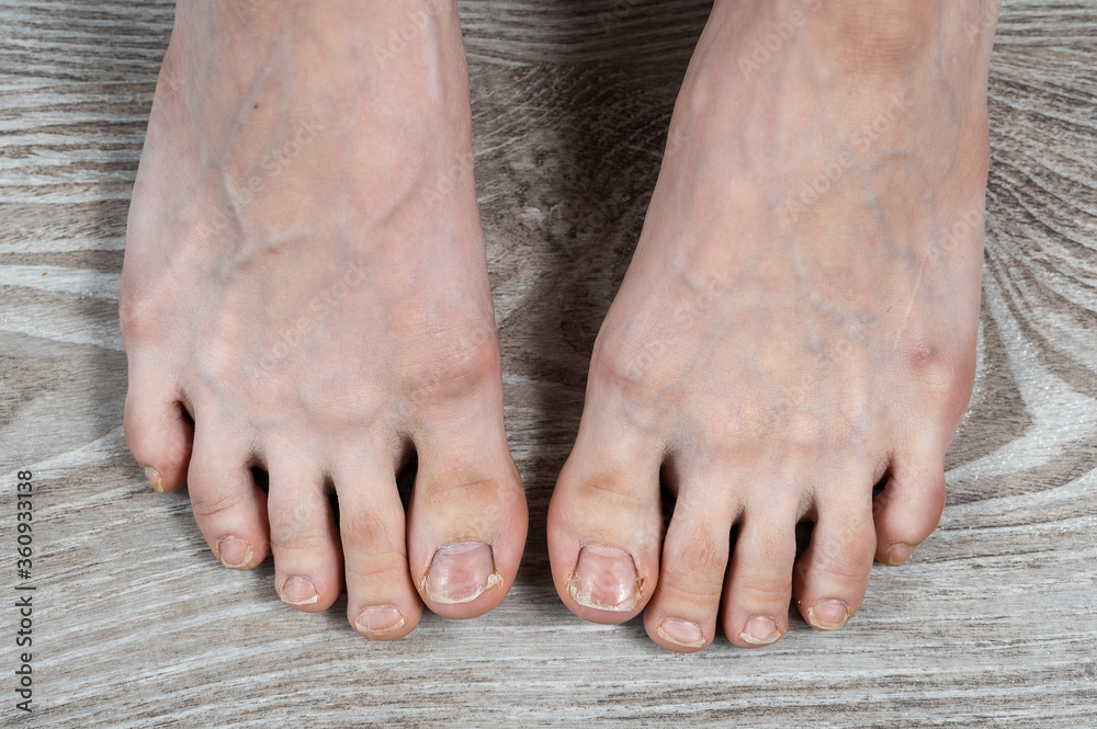 groomed female legs with ugly broken nails and calluses