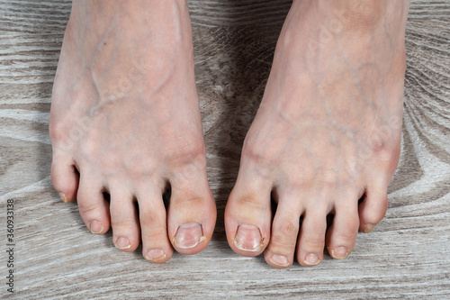 Obraz na płótnie groomed female legs with ugly broken nails and calluses w salonie