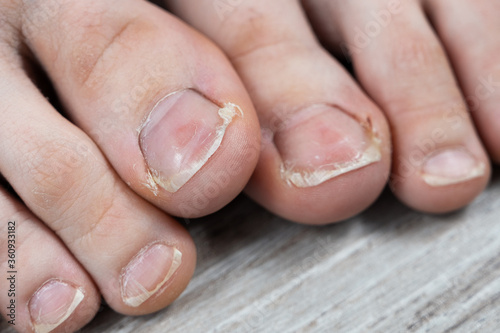 Obraz na płótnie ugly toes of a girl with a fungus and ingrown toenails and dry skin on her feet w salonie