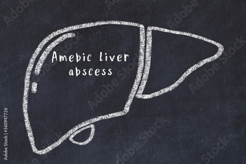 Chalk drawing of human liver with medical term. Concept of learning medicine photo