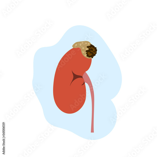 Adrenal gland tumor. Disease. Medical flat anatomy illustration.