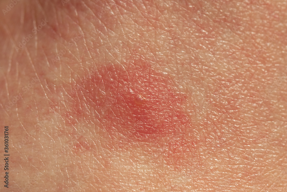 Fototapeta premium closeup of a bug bite on human skin by biting midges