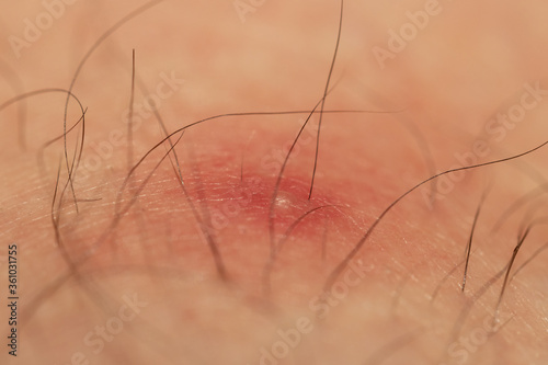 closeup of a bug bite on human skin by biting midges with selective focus photo