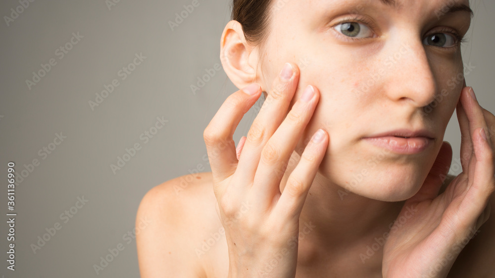 woman with acne skin care